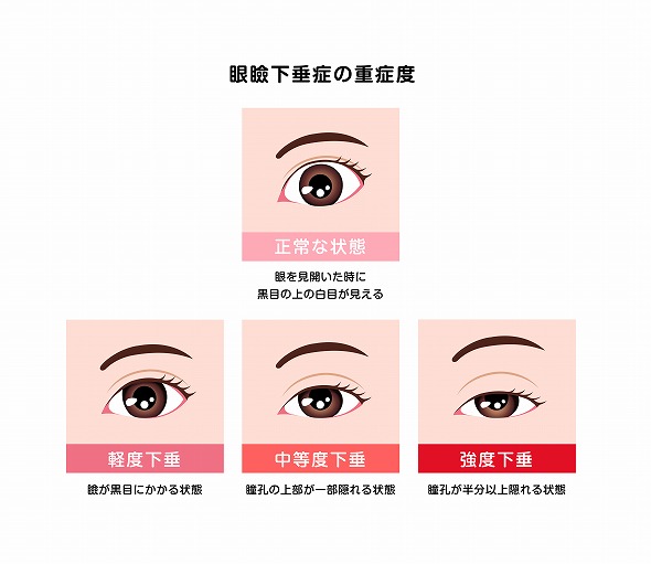 大阪で保険適用の眼瞼下垂ならSOWACA乳腺・形成外科クリニック大阪